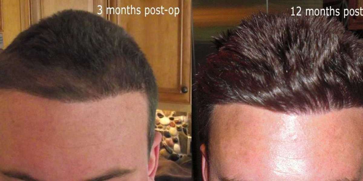Hair Transplant Recovery Timeline: Expectations vs Reality
