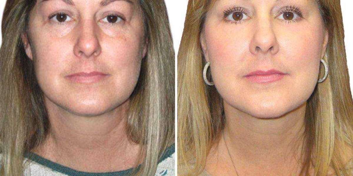 Transform Your Look With Cheek Reduction Surgery