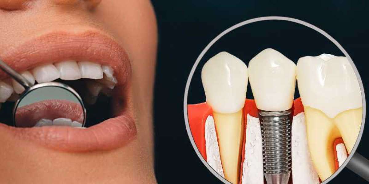Everything You Need to Know Before Getting Dental Implants