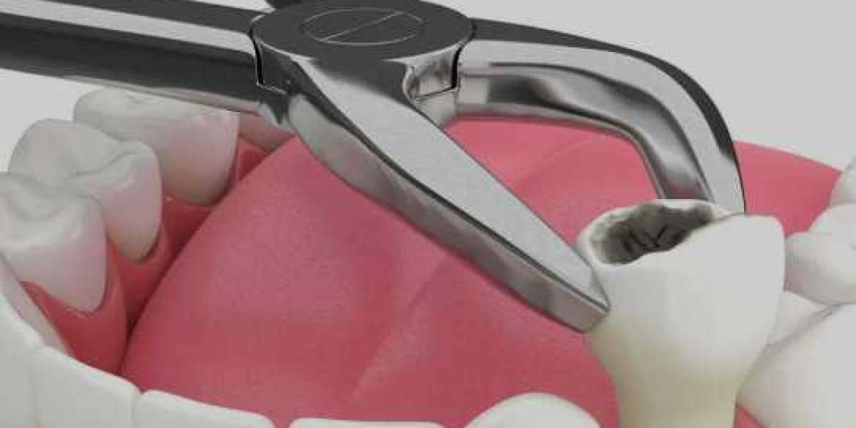 Safe and Comfortable Tooth Extraction in Tampa for a Healthier Smile