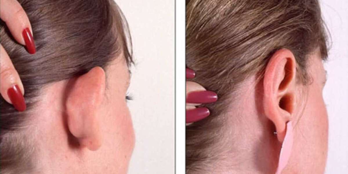 Choosing the Right Ear Reshaping Surgeon in Islamabad