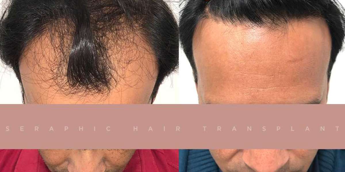 Best Doctor for Hair Loss – Expert Care for Lasting Results