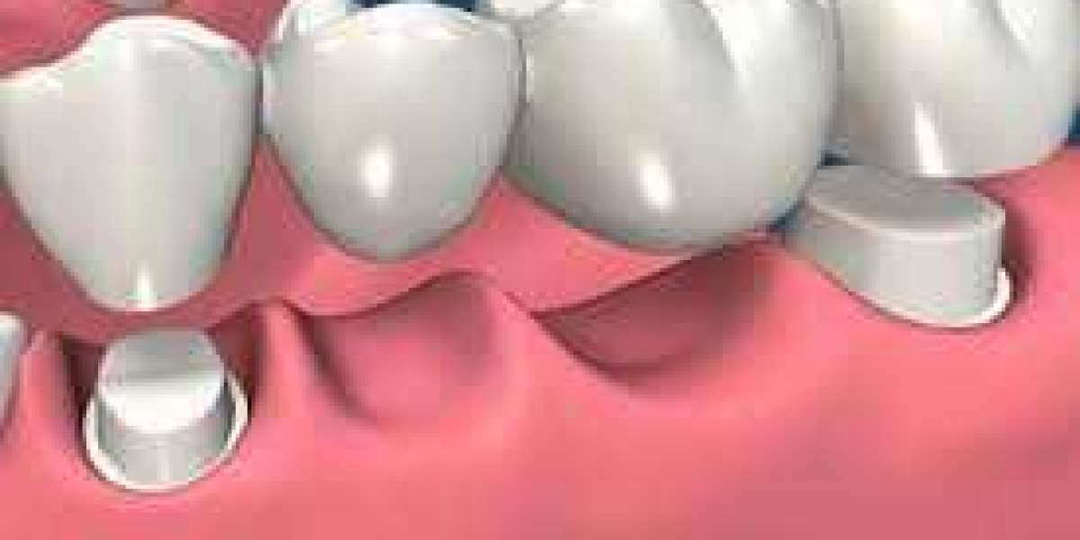 Understanding Dental Crowns in Rochdale