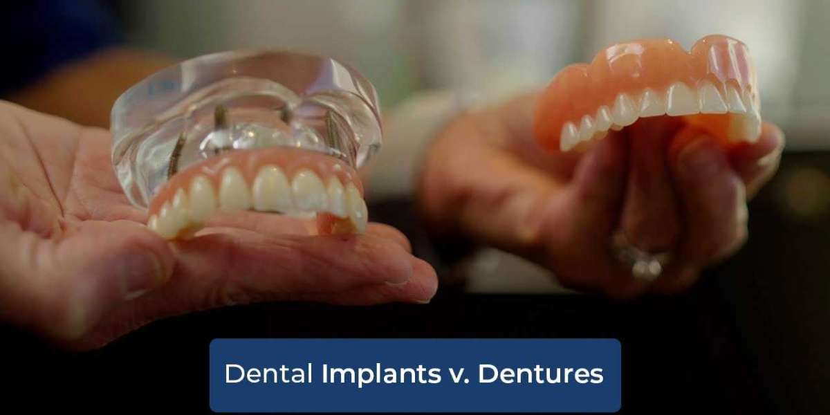 Dental Implants vs. Dentures: Which Is Right for You in Texas?