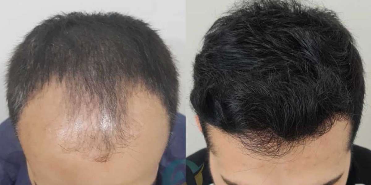Restore Hair Naturally with PRP Treatment in Islamabad