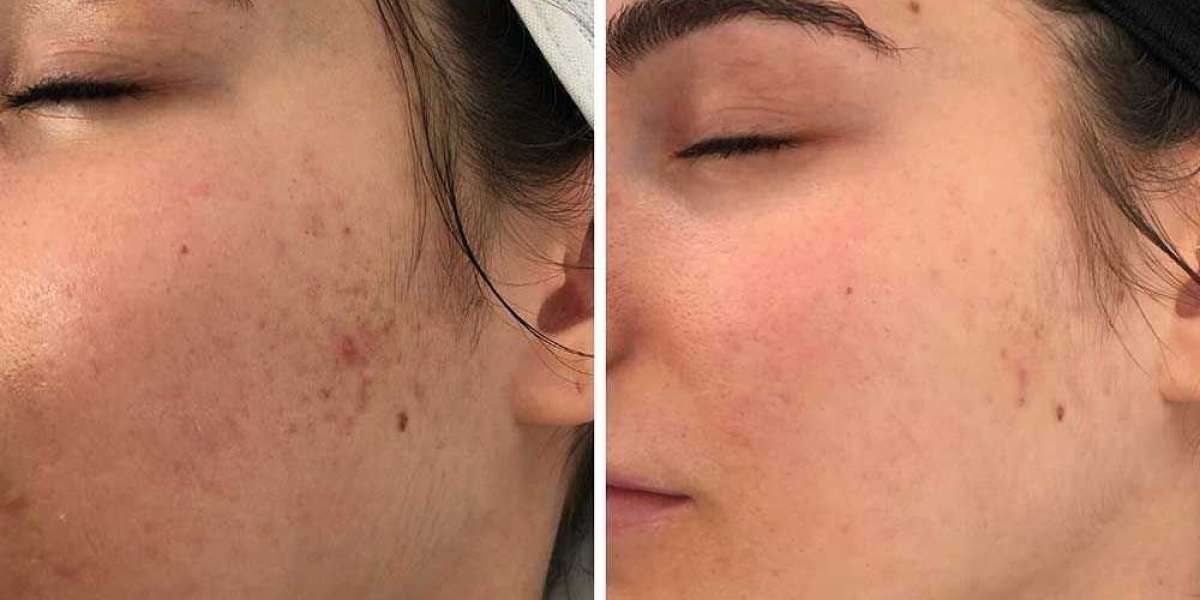 Best Microneedling for Acne Scar Treatment in Islamabad