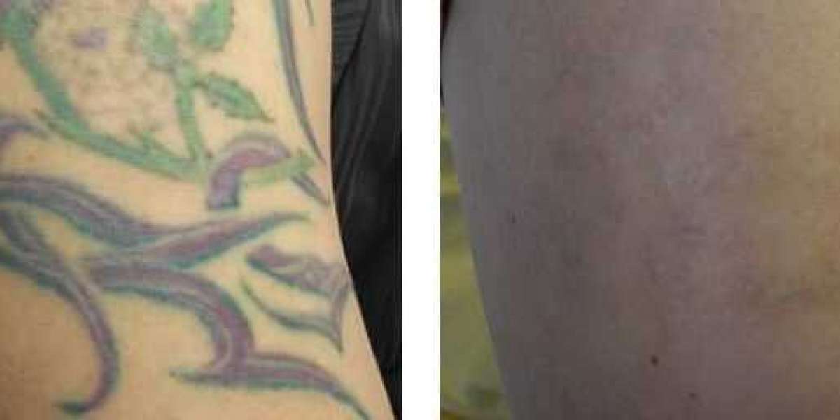 Safe and Effective Tattoo Removal in Islamabad
