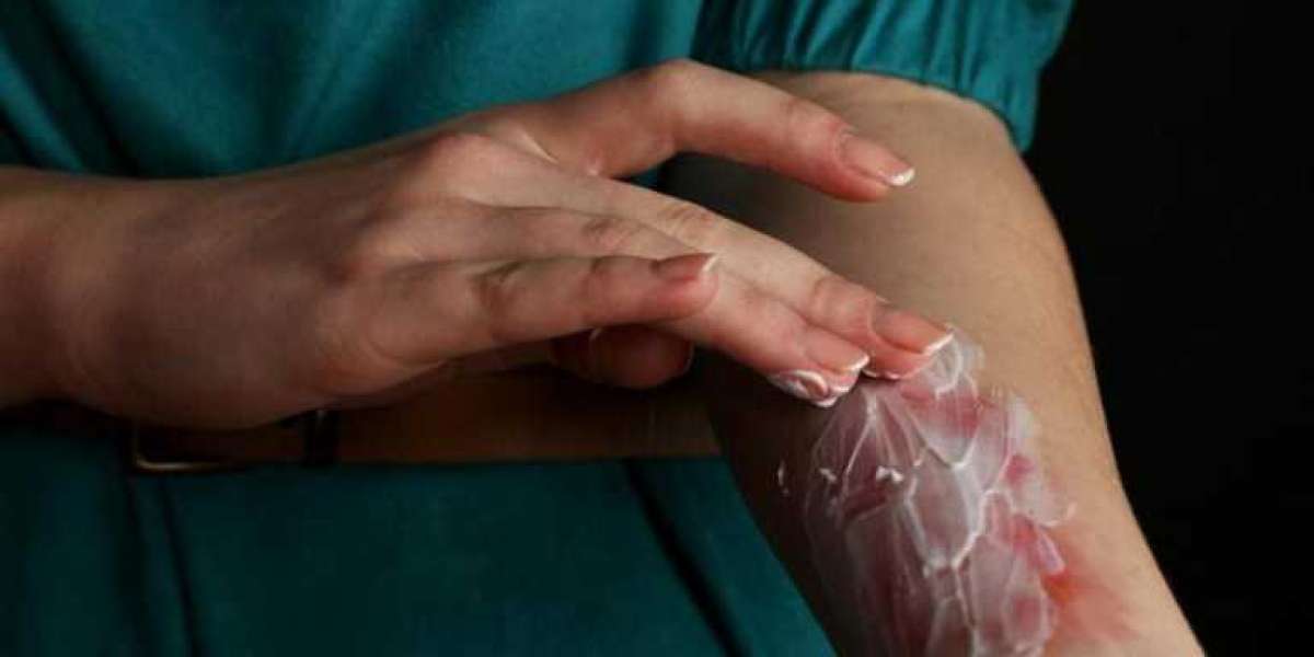 Homeopathy and the Underperformance of Conventional Treatments in Vitiligo