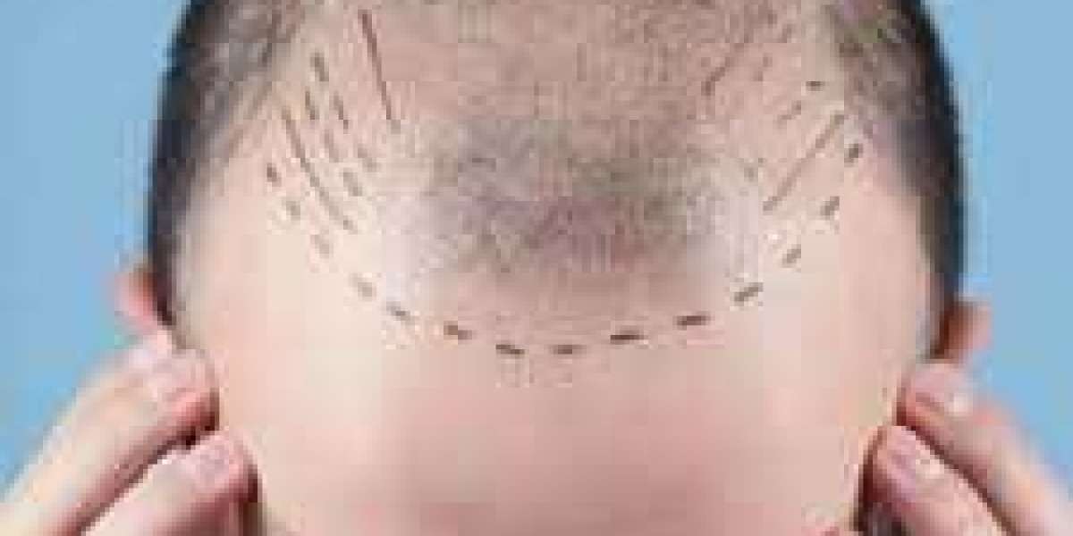 دليلك الشامل حول زراعة الشعر في الرياض: التقنيات، التكلفة، والنتائج المتوقعة