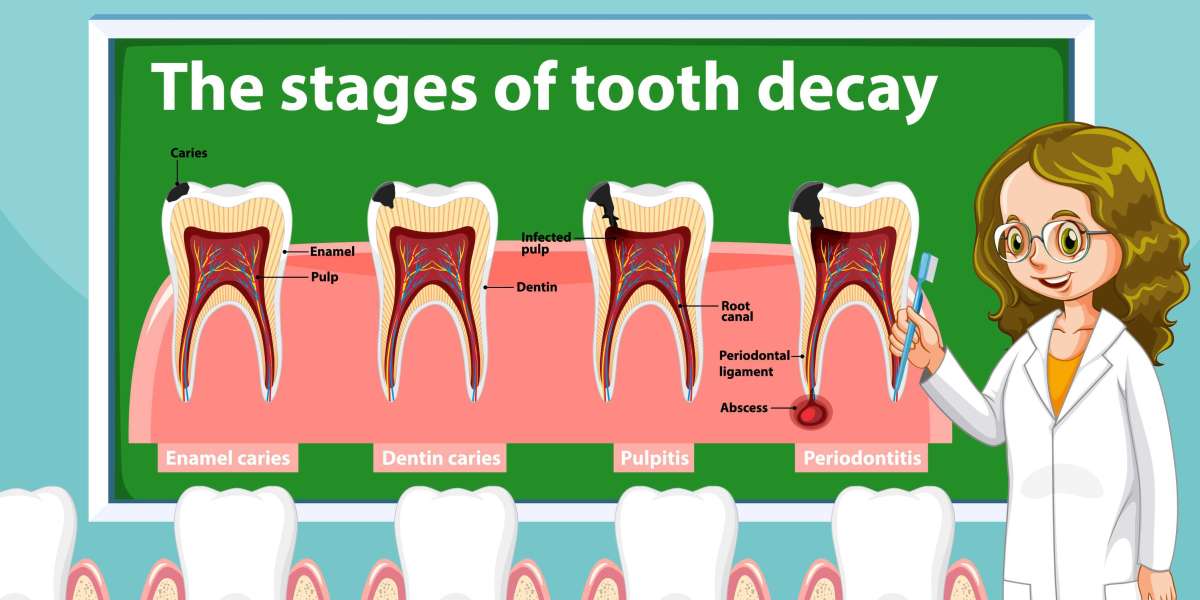 From Cavities to Root Canal: Understanding Dental Disease Stages