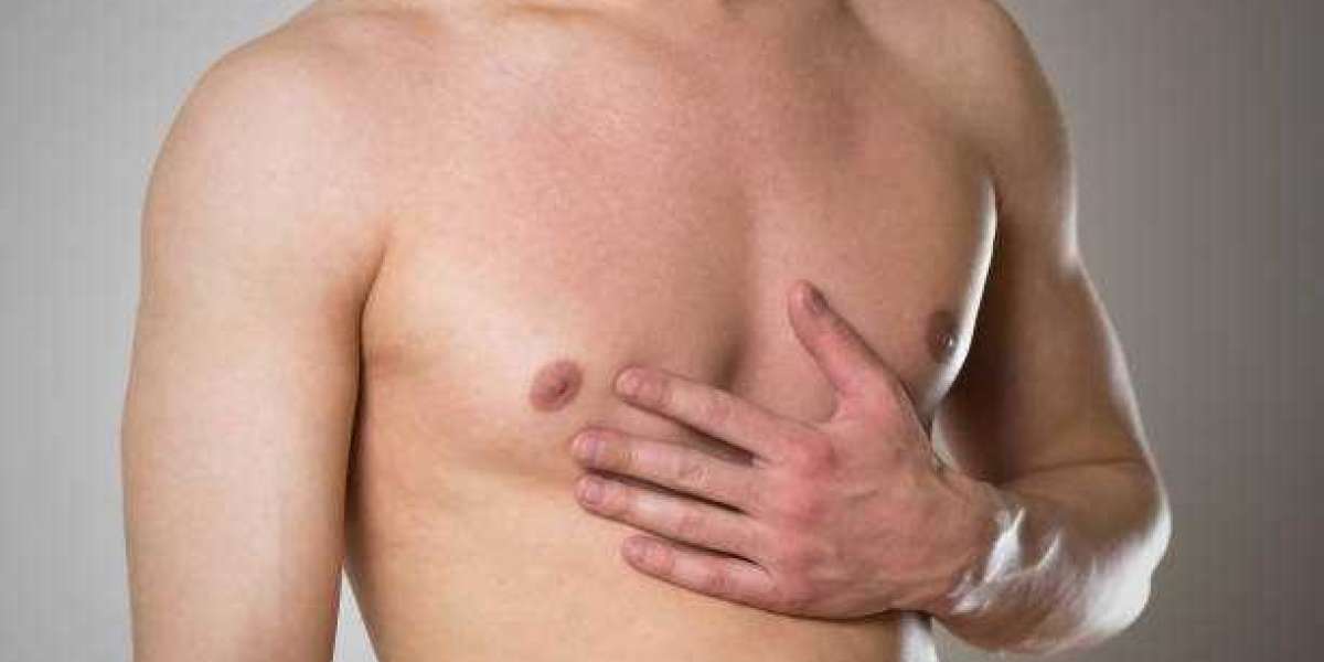 Gynecomastia Male Breast Reduction for Lasting Chest Confidence