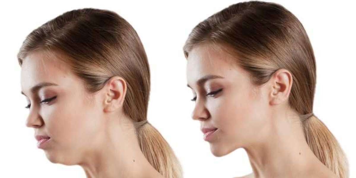 Jaw Surgery in Islamabad for Long-Term Bite Correction