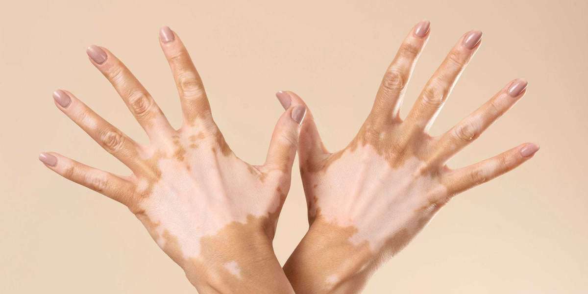 Complete Skin Care Guide for Vitiligo Treatment in Islamabad