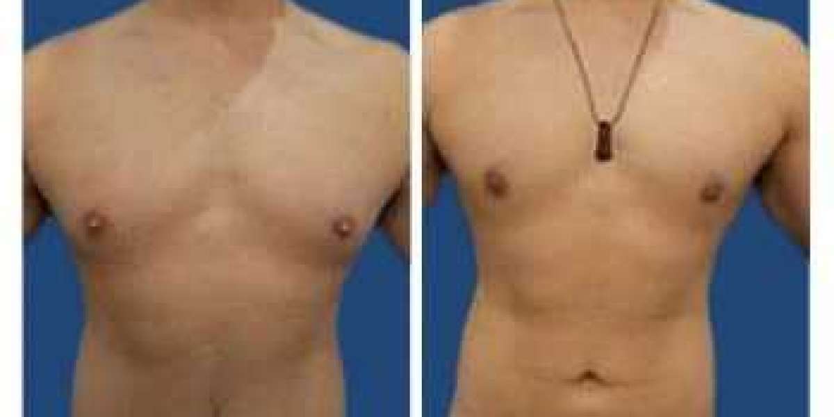 Trusted Gynecomastia Specialists in Islamabad
