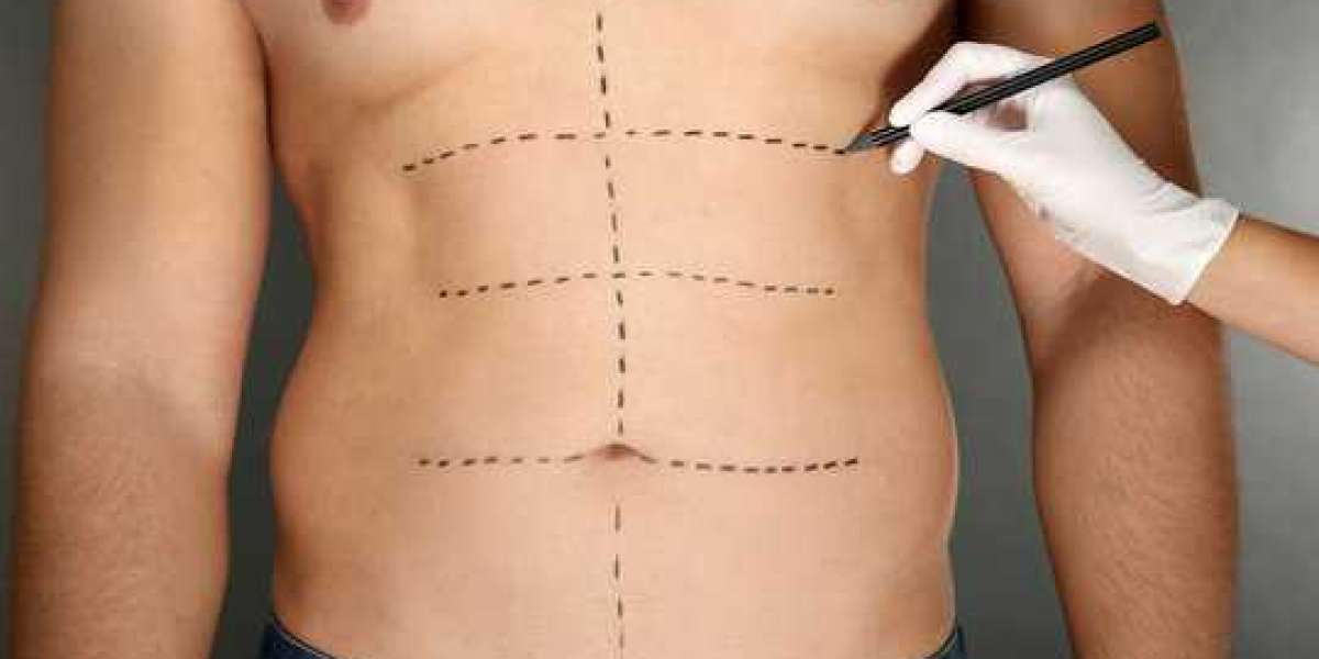 High-Definition Sculpting: The Art of Liposuction Riyadh