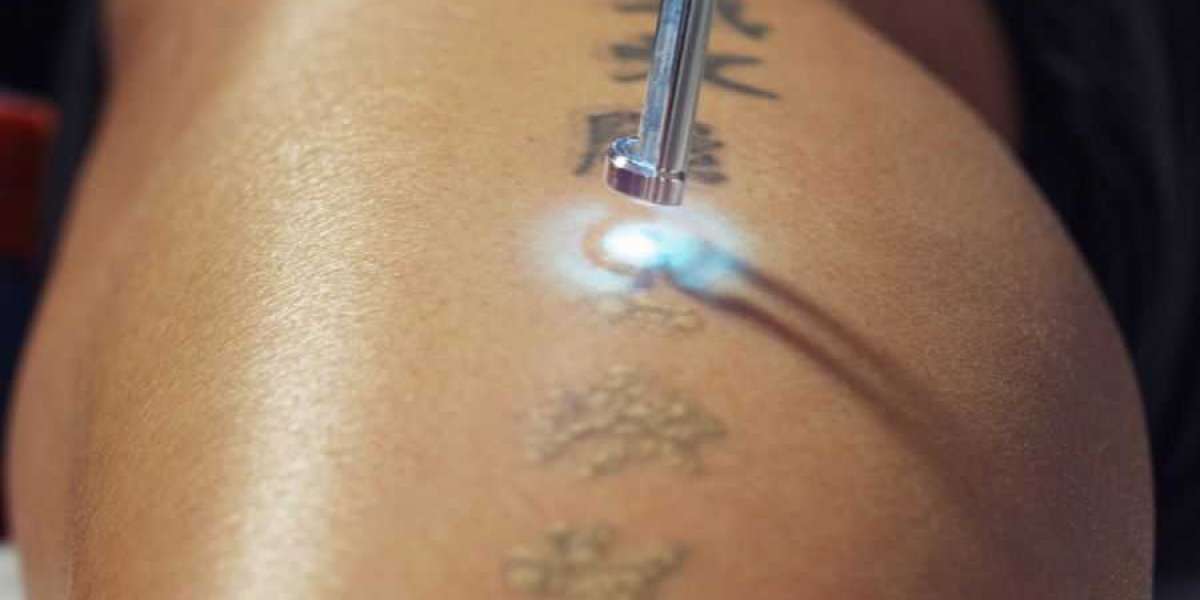 Precision-Based Laser Tattoo Removal by Specialists