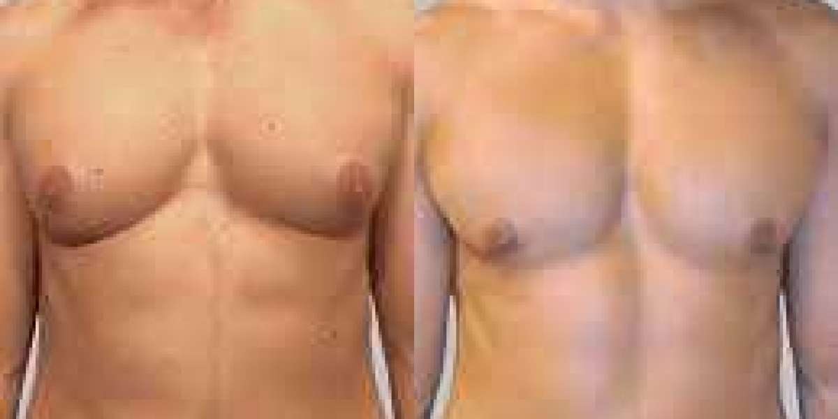 Gynecomastia Reduction Surgery in Islamabad: What to Expect