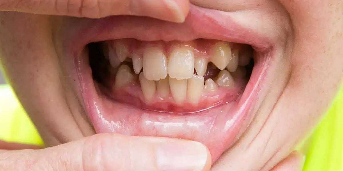 How Early Crooked Teeth Treatment Can Prevent Problems Later