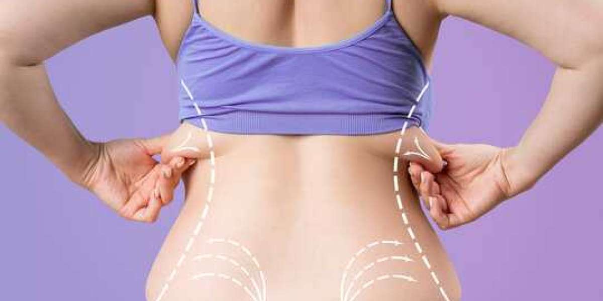 Non-Surgical Liposuction Alternatives: What Works?