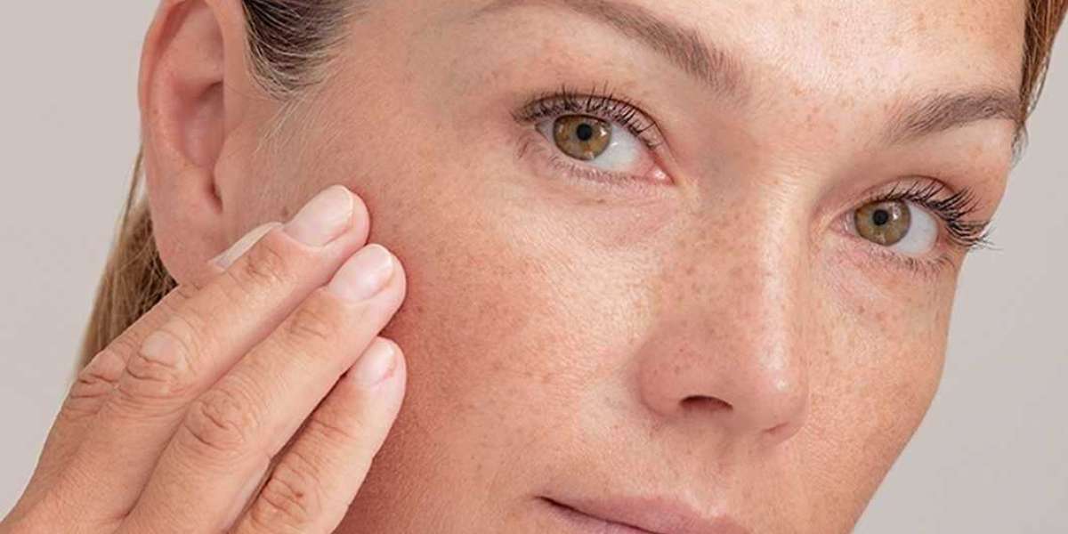 Melasma treatment in Islamabad Pro Choice