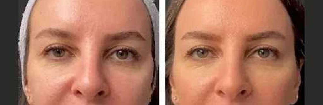 Mesotherapy Dubai Cover Image