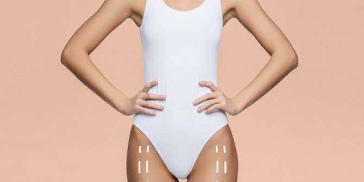 BodyTite vs. Traditional Liposuction: Pros and Cons