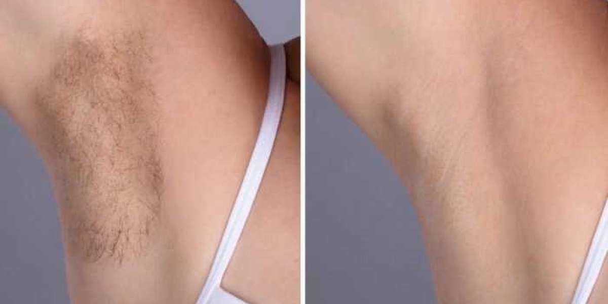Best Aesthetic Clinic in dubai for Facial Laser Hair Removal