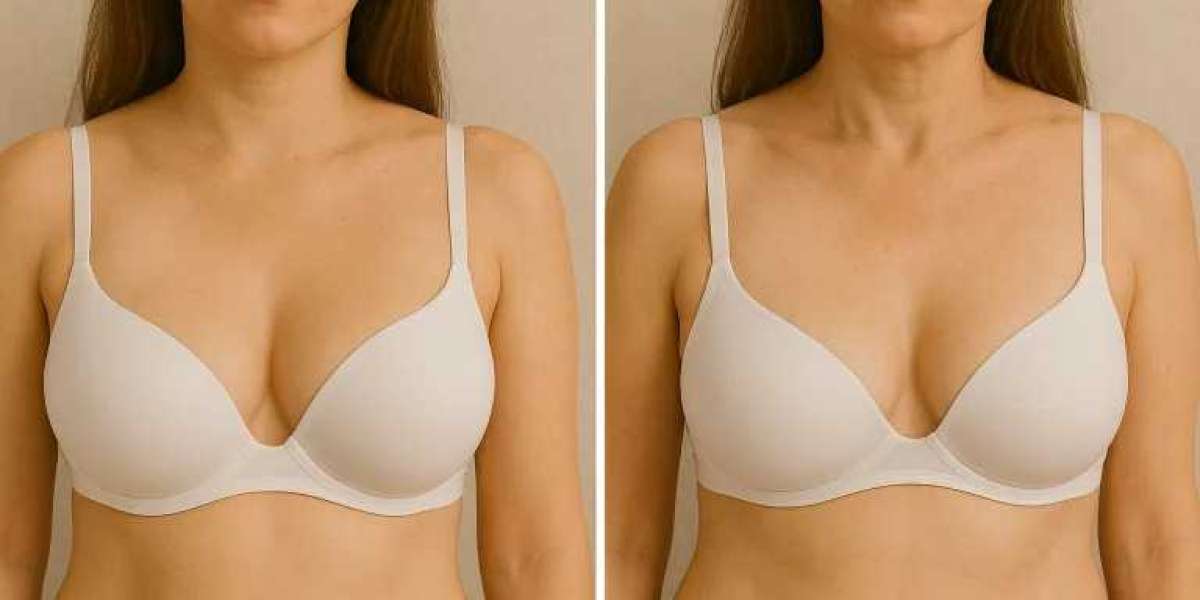 Is Breast Fat Transfer in Dubai Painful? What to Expect