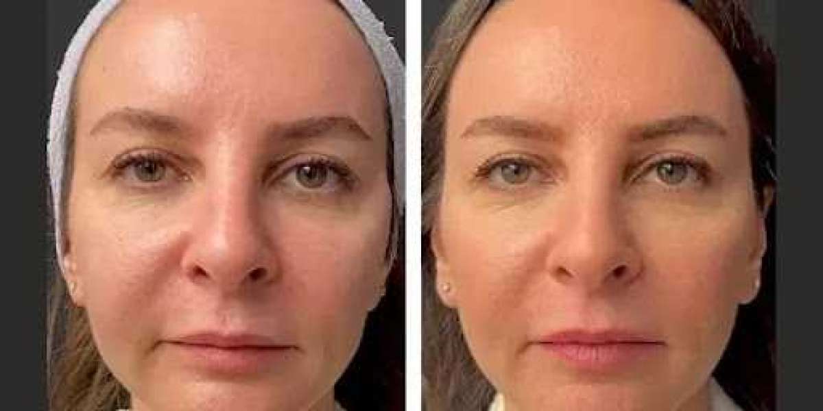 Collagen Mesotherapy – Best Aesthetic Clinic in Dubai