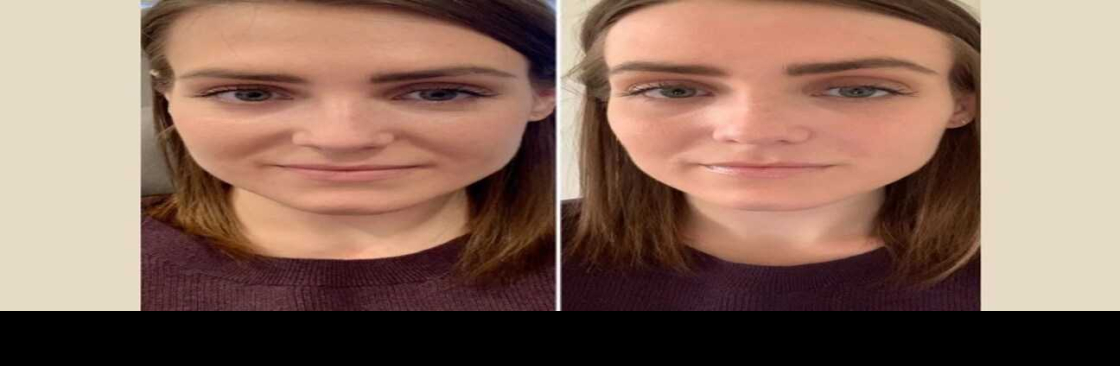 PRP Treatment Cover Image