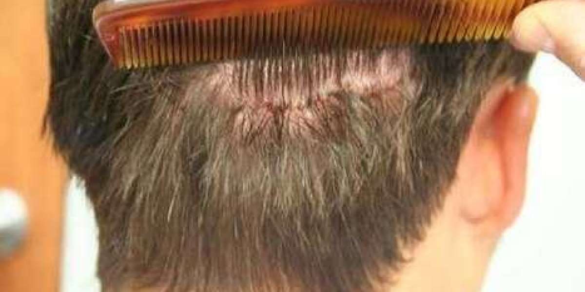 Financing Your Future: Hair Transplant in Riyadh Payment Plans