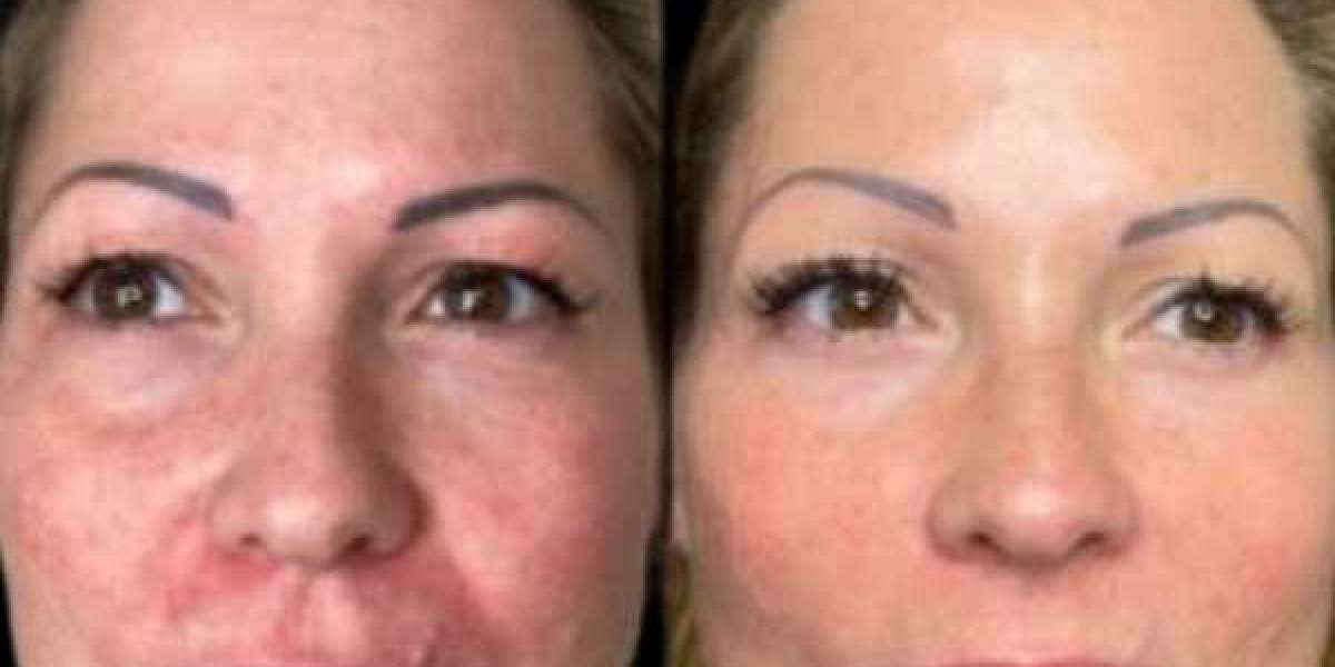 What Makes Profhilo Treatments in Dubai Unique?