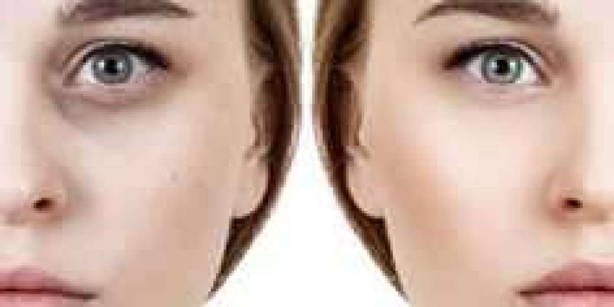 Unlock Clear Eyes: Holistic Dark Circles Treatment Method