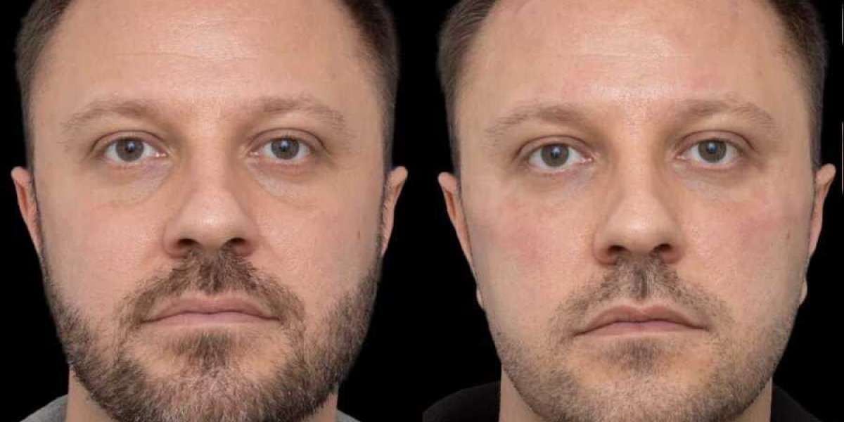 Maintenance Schedule for Under Eye Fillers Treatment in Dubai