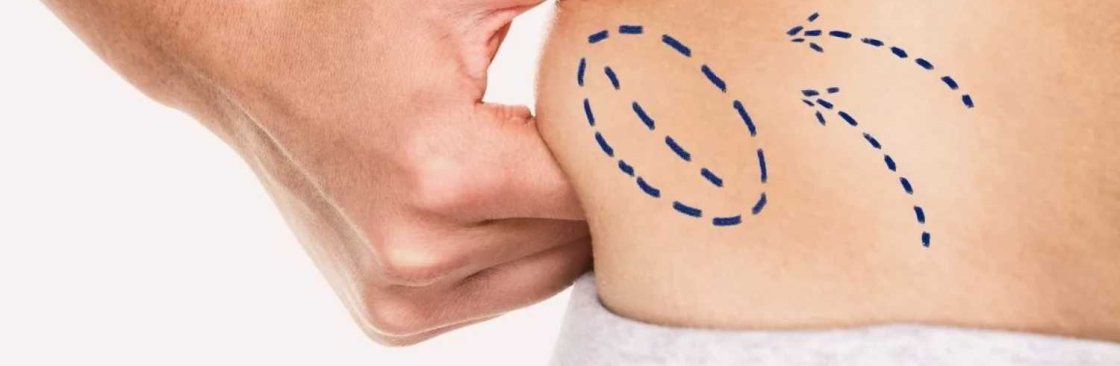 Liposuction Surgery Cover Image