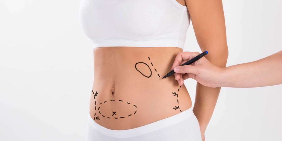 Tummy Tuck Dubai: Before and After Expectations