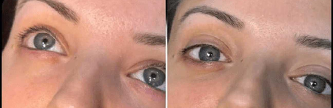 dermal fillers Cover Image