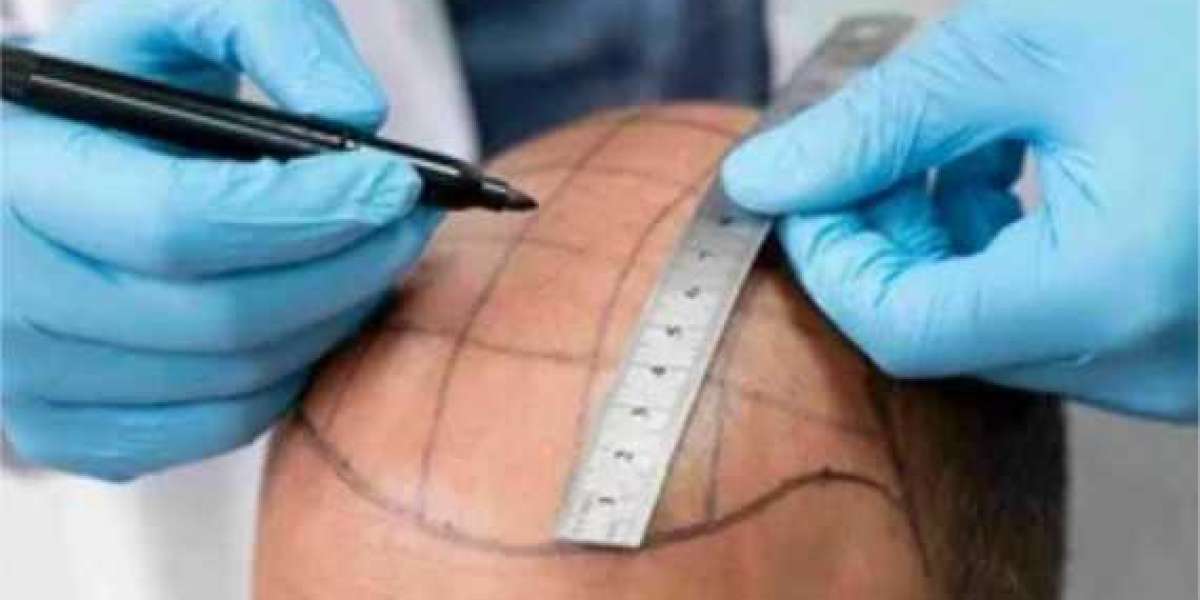 Avoiding "Hair Mills": How to Spot a Certified Surgeon in the Middle East