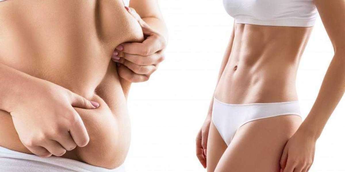 Top Best Liposuction Surgeon in Dubai for Customized Body Contouring