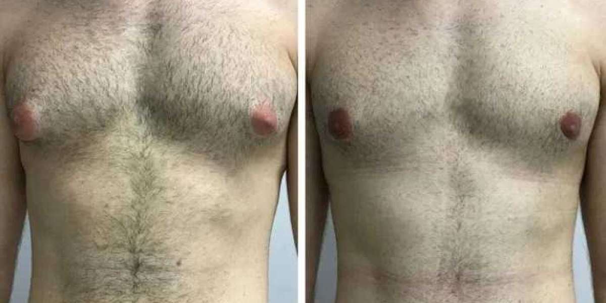 How the Best Gynecomastia Surgeons in dubai Manage Pain and Recovery