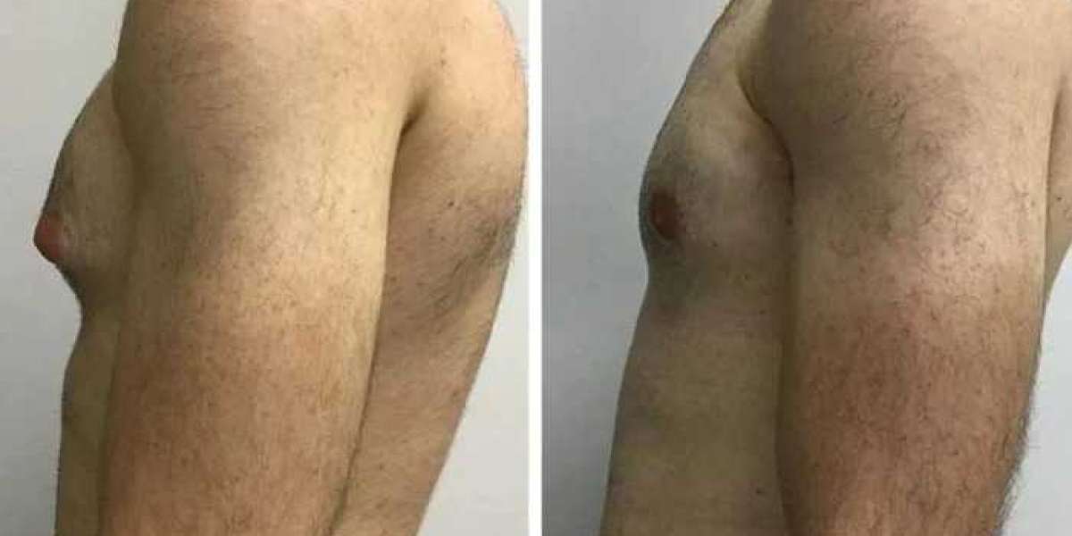 Trusted Gynecomastia Surgery in Dubai by Experienced Surgeons