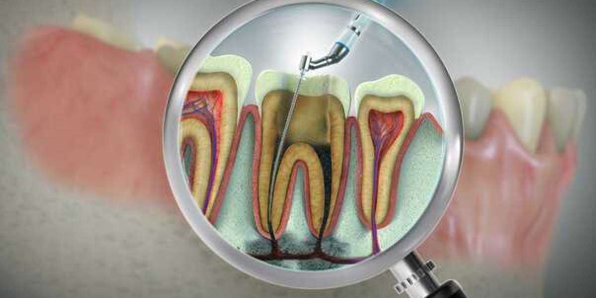 Effortless Root Canal Treatment | Royal Clinic Saudia – Smile Confidently