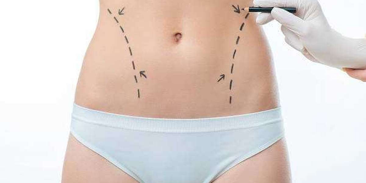 Redefine Your Silhouette Using BodyTite Liposuction