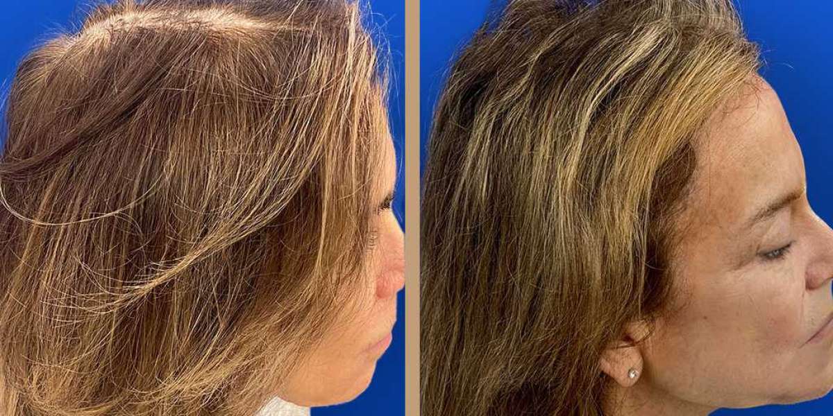 Achieving Natural Results with Advanced Hair Restoration