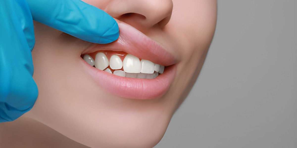 Gum Recontouring Treatment: Refining Your Smile with Precision and Care