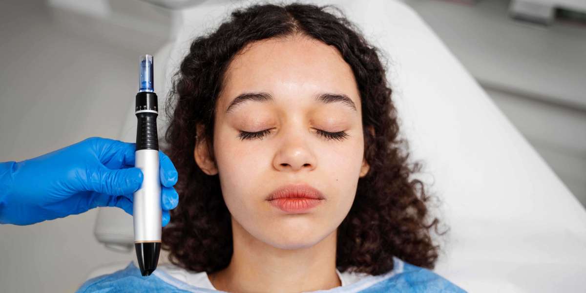 Secret RF Microneedling for Controlled Dermal Remodeling