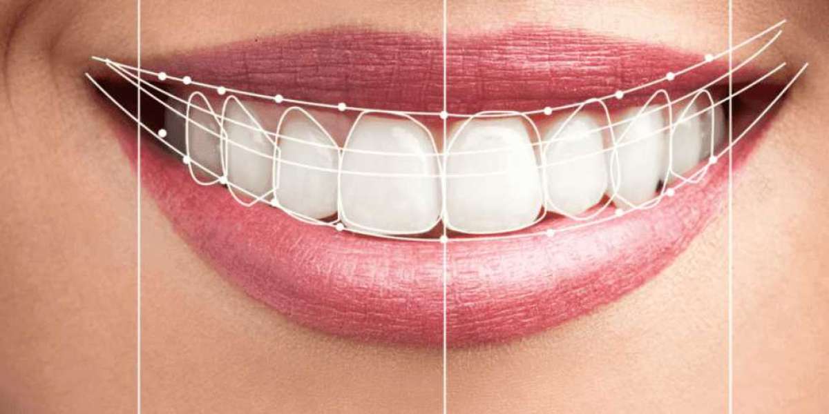 Digital Smile Design Dubai for Customized Smile Results