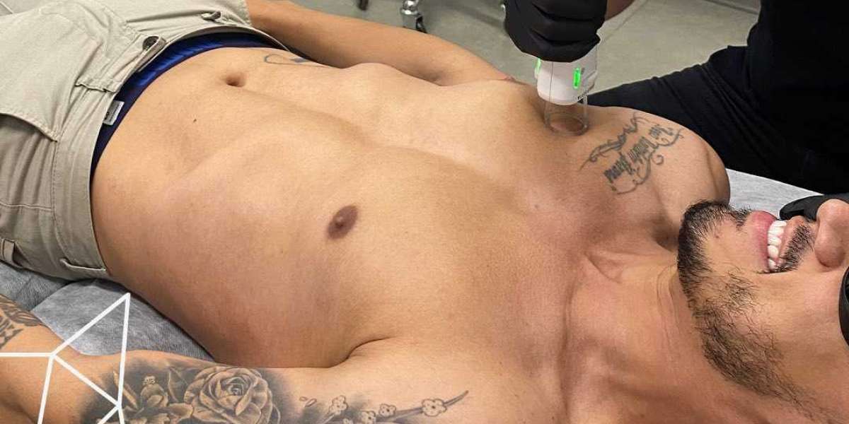 Advanced Men’s Laser Treatments in Barangaroo