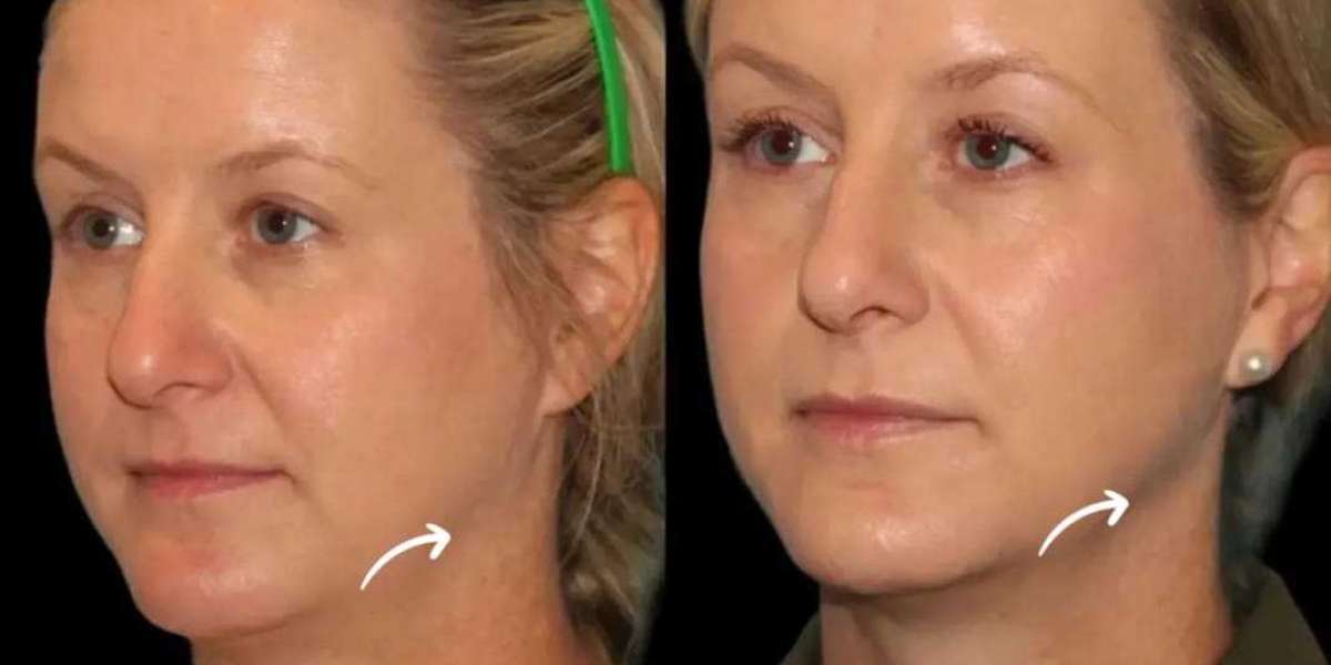 Sculptra for Advanced Skin Lifting by Best Plastic Surgeons in Dubai