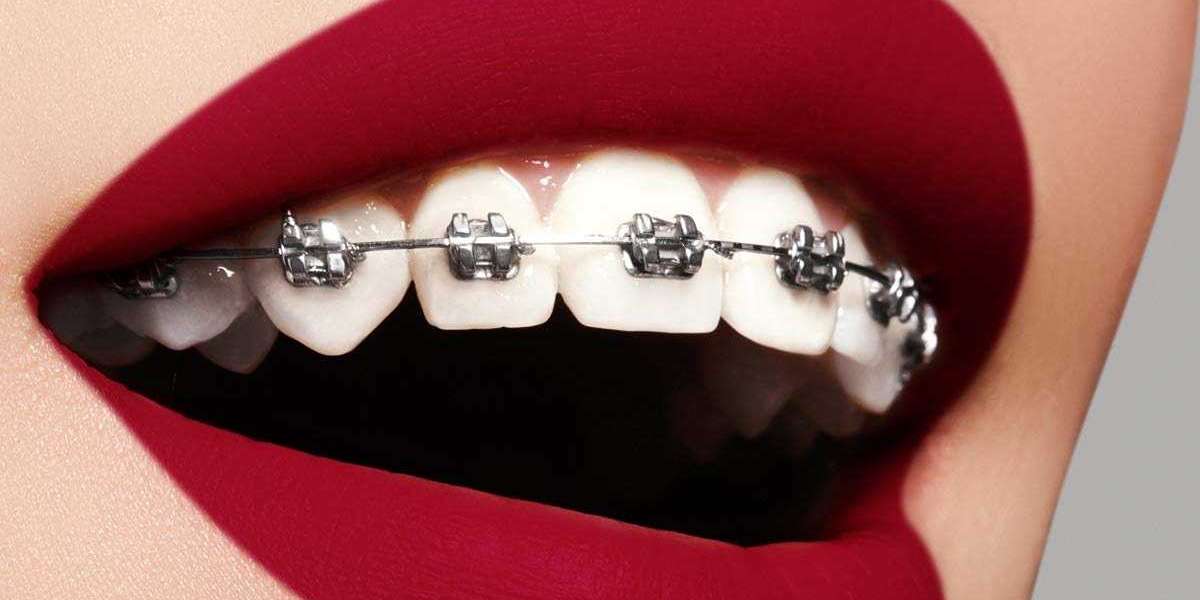 How Dental Braces in Dubai Improve Oral Hygiene and Prevent Tooth Decay